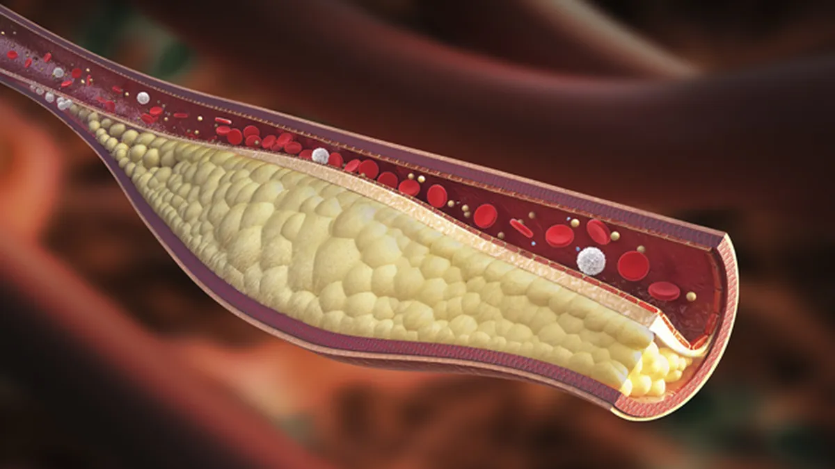 Nanobots para limpieza de arterias: La revolución médica a escala microscópica